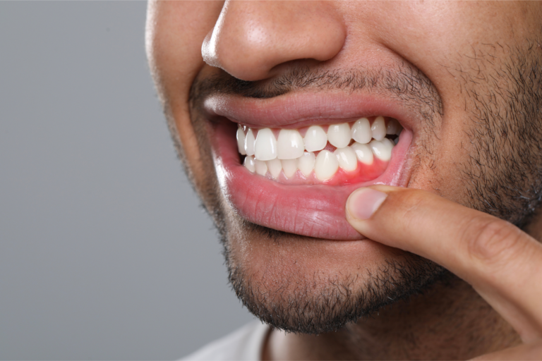 Oral Pathology sore gums man using finger to pull back lip to see red gums